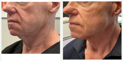 55-64 year old man treated with Thread Lift, Contour Thread Lift - This gentleman presented concerned that his face appeared heavier despite having a naturally petite facial frame and strong underlying bone structure. He noted progressive deepening of the nasolabial folds and early jowl formation that softened his jawline. A customized thread lift was performed to reposition and support the midface and lower face without adding volume. The result is a more defined, structurally supported appearance with improved contour and a sharper jawline while maintaining his natural features.