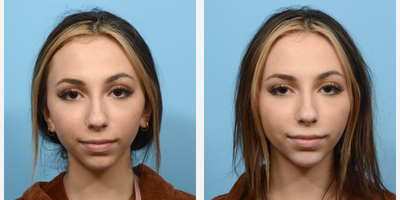 18-24 year old woman treated with Chin Filler - This 21-year-old patient turned to Dr. Wise for a more defined jawline and increased projection for her chin. Not quite ready to commit to chin implant surgery, she opted for dermal fillers and is thrilled with the beautiful outcome.