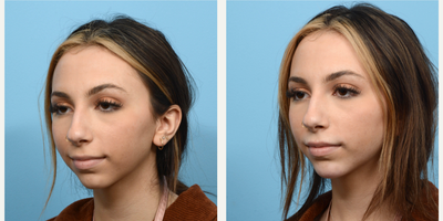 18-24 year old woman treated with Chin Filler - This 21-year-old patient turned to Dr. Wise for a more defined jawline and increased projection for her chin. Not quite ready to commit to chin implant surgery, she opted for dermal fillers and is thrilled with the beautiful outcome.