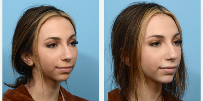 18-24 year old woman treated with Chin Filler - This 21-year-old patient turned to Dr. Wise for a more defined jawline and increased projection for her chin. Not quite ready to commit to chin implant surgery, she opted for dermal fillers and is thrilled with the beautiful outcome.