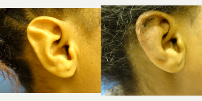 45-54 year old woman treated with Ear Surgery - Otoplasty for a congenital ear deformity.Note:1 week post operative.