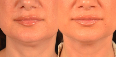 45-54 year old woman treated with Kybella - Kybella for chin fat reduction and neck rejuvenation (3 weeks later, 1 treatment)