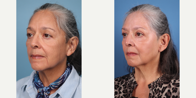 70 year old woman treated with Phenol Peel & Facial Fat Transfer to Temples, Tear Troughs, and Cheeks - Dr.Sukkar performed a Phenol Peel & Facial Fat Transfer to Temples (1cc per side), Tear Troughs (1cc per side), and Cheeks (5cc per side) to this 70 year old patient.