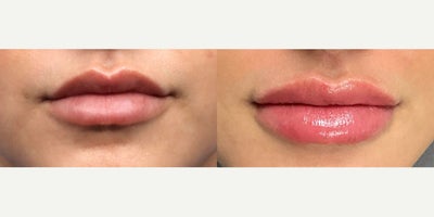 25-34 year old woman treated with RHA Collection Fillers, Lip Fillers - For a subtle change, NP Mayra injected this patient's lips with RHA 2. The patient was happy with how natural the results look.