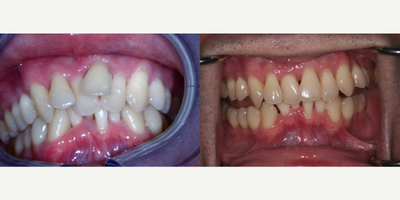 25-34 year old man treated with DNA Appliance - Patient has severely underdeveloped dental arches, thus the crowding and overlapping of teeth. After arch development treatment, patient is now ready to have braces placed over the teeth for straightening. No tooth extractions were required before braces. Ultimately, the patient will now have a healthier TMJ, improved airway flow, and more enhanced facial aesthetics now that the dental arches are fully developed to their natural size.