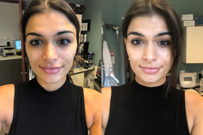 Woman treated with HydraFacial - Woman treated with HydraFacial
