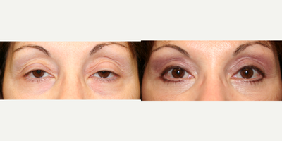Age-related droopy upper eyelids/ptosis in late 50s female - Ptosis or drooping of the eyelids can be age-related, when the muscle that lifts the upper eyelids called the levator muscle weakens and stretches with age. The lengthened muscle causes the eyelids to droop and cover the pupil, and can affect vision, making corrective surgery a necessity. Ptosis correction surgery is done exclusively by oculoplastic/ oculofacial plastic surgeons.