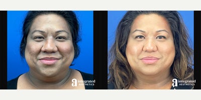 35-44 year old woman treated with AccuTite, Thread Lift, Facial Fat Transfer, Rhinoplasty, Buccal Fat Removal - The patient is a 42-year-old transgender female who has concerns with the appearance of her lower, face, neck, and nose. Dr. Cho performed Accutite and MyEllevate to the lower face and neck, fat grafting to the face, Alar Width and Internal Nare Reduction to the nostrils, and buccal fat removal. The after results are 4 months post-procedure.