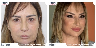 45-54 year old woman treated with Deep Plane Facelift, Facial Fat Transfer, Lip Lift - 45-54 year old woman treated with Deep Plane Facelift, Facial Fat Transfer, Lip Lift