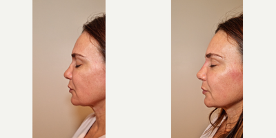 25-34 year old man treated with Nonsurgical Nose Job - Non surgical nose enhancement using dermal filler