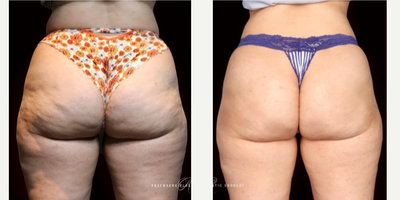 18-24 year old woman treated with Qwo - Patient was injected with QWO to get rid of cellulite.