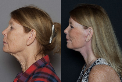 Over 60 year old woman treated with CO2 Laser - Over 60 year old woman treated with CO2 Laser