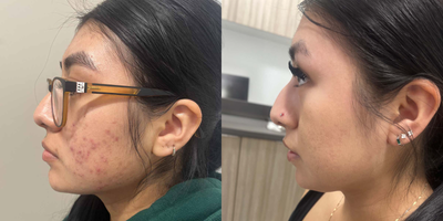 19 year old woman treated with Accutane - This 19 year-old patient was struggling with active acne, after taking Accutane for 6 months her skin is acne and blemish free!
