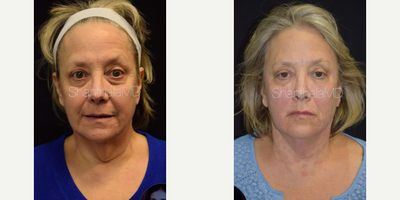 Woman treated with Vampire Facial - Woman treated with Vampire Facial