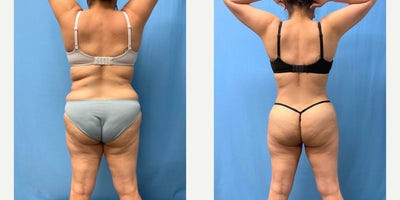 45-54 year old woman treated with Liposuction - Lipo 360 by Dr. Pey-Yi Kevin Lin at Chicago Breast & Body Aesthetics