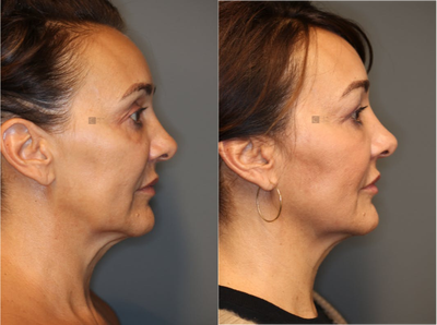 Pan Facial Rejuvenation - Upper and lower lid filler, temple and jawline rejuvenation.