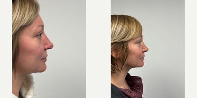 35-44 year old woman treated with Rhinoplasty - 3 weeks after a Rhinoplasty