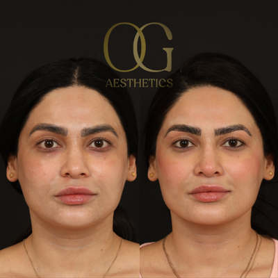 35-44 year old woman treated with Revision Rhinoplasty, Asian Rhinoplasty - 38 yo F who underwent revision rhinoplasty with autologous rib and temporalis fascia