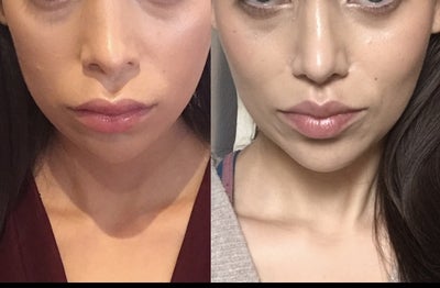 Selcuk Yazan Revision Rhino And Lip Lift Review Realself