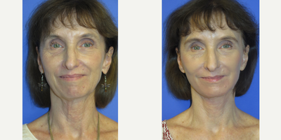 55-64 year old woman treated with Lifestyle Lift - 63 year old female seeking rejuvenation of her lower face and specifically her jowls, jawline, and neck. She also had her lower eyes and mouth treated with CO2. She had a lower facelift with neck lift under local anesthesia.