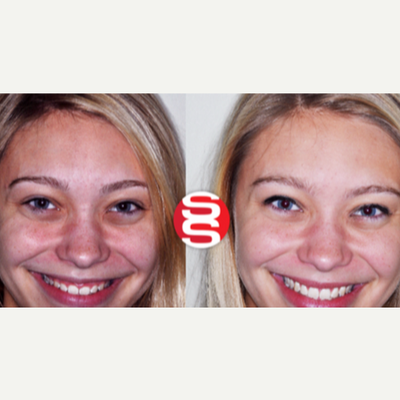 18-24 year old woman treated with Gum Lift - 18-24 year old woman treated with Gum Lift