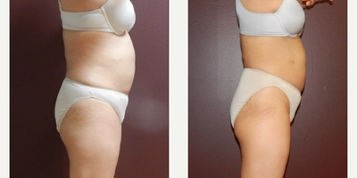 UltraSlim - Woman treated with UltraSlim