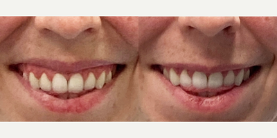 18-24 year old woman treated with Xeomin - 18-24 year old woman treated with Xeomin for a gummy smile