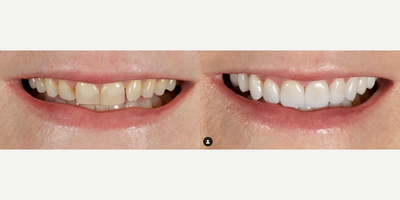 Woman treated with Dental Crown - Treatment: 10 upper and 10 lower restorations using porcelain veneers and dental crownsTime: 2 visits, approximately 2 weeks apart