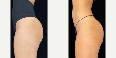 Woman treated with truSculpt, truFlex - Woman treated with truSculpt, truFlex