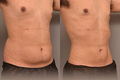 Man treated with Liposculpture - Man treated with Liposculpture