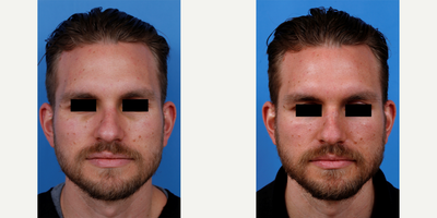 Man in his late 20s treated with Facial Reconstructive Surgery - Man in his late 20s treated with Rhinoplasty and Facial Reconstructive Surgery. Patient sustained an acute nasal bone fracture while in martial arts training, resulting in significant nasal deviation. The nasal bones were carefully reduced to restore his original pre-injury appearance.