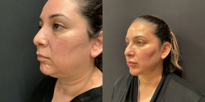 Woman treated with Chin Liposuction - Woman treated with Chin Liposuction