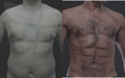 4D Lipo Men - 4D Lipo with fat transfer to pectorals