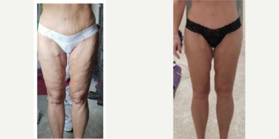 45-54 year old woman treated with Skin Tightening - Renuvion skin tightening thighs arms and abdomen