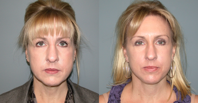 45-54 year old woman treated with Facelift - This 50 year old woman presented requesting facial rejuvenation. She had a brow lift, upper eyelid lift, and lower face and neck lift. She is 5'5 tall and weighs 125 lbs. her results are shown a 6 months after the procedure.