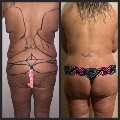 Belt Lipectomy  Julian Plastic Surgery