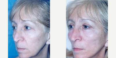 Woman treated with Thread Lift - Woman treated with Cheek Lift andThread Lift