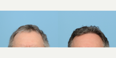 55-64 year old man treated with FUE Hair Transplant, Hair Transplant, Hair Loss Treatment, PRP for Hair Loss, NeoGraft - This 57-year-old patient was experiencing front hairline recession and overall thinning. To correct these issues, Dr. Wise transplanted 2,230 grafts to zone 1, in addition to a treatment of PRP. 6 months post-op the patient's is enjoying the amount of growth he is seeing and will continue to see results up to the one year mark.