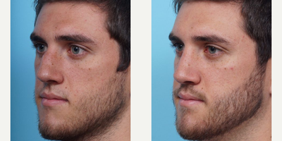 Man treated with Rhinoplasty - This patient was bothered by his wide large hump. Dr. Balikian performed a Septoplasty to improve his breathing and hump reduction via open Rhinoplasty.
