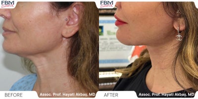 25-34 year old woman treated with Mini Neck Lift - 25-34 year old woman treated with Mini Neck Lift