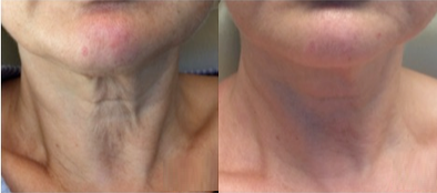 65-74 year old woman treated with eMatrix - Elos Plus EMatrix Sublative Fractional with Radio Frequency and Kybella injections one month after one treatment on the neck