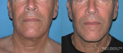 Man treated with Neck Lift - Man treated with Neck Lift