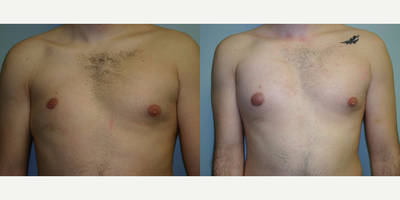 18-24 year old man treated with Breast Reconstruction - 18-24 year old man treated with Breast Reconstruction