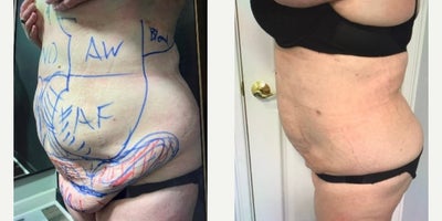 Woman treated with Renuvion - Woman treated with Renuvion