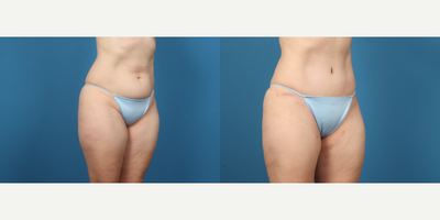 45-54 year old woman treated with Tummy Tuck, Liposuction - Abdominoplasty with suction assisted lipectomy of bilateral hips.