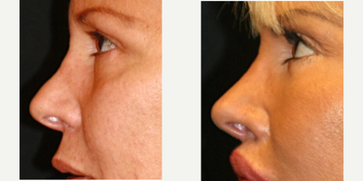 65-74 year old woman treated with fat transfer Nose Job - This woman had three previous rhinoplasties. She was unhappy with her uneven nasal dorsum (bridge) and tip. In addition to a facial rejuvenation as well as lower eyelid surgery with fat transfer , she opted to get fat transfer to her nose to improve the appearance.