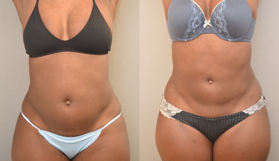 38 year old woman treated with SAFELipo - 38 year old woman treated with SAFELipo