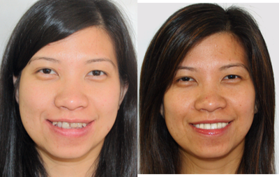 25-34 year old woman treated with Snap-On Smile - Patients sister was getting married in less than a month and she wanted to look her best. Permanent dental treatment would take longer than she had (probably at least a year due to some jaw re positioning). She opted for snap-on smile to give a new smile in about 1 week that she could proudly wear to the wedding.