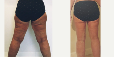 35-44 year old woman treated with Thigh Lift - Tired of feeling self-conscious about the appearance of your thighs? Dr. Meegan Gruber's Awake Thigh and Knee liposuction with Spiral Thigh Lift can help you achieve a smoother, more toned appearance. The before and after photos of Dr. Gruber's patients speak for themselves - this procedure can make a transformative difference in the contours of your thighs, giving you a newfound confidence in your body. Trust Dr. Gruber's expertise and experience to give you the results you deserve. Book your appointment today and take the first step towards the body you've always wanted!