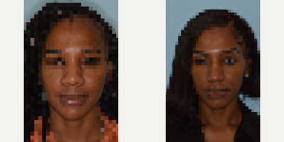 Woman treated with Rhinoplasty, African American Rhinoplasty - Woman treated with Rhinoplasty, African American Rhinoplasty